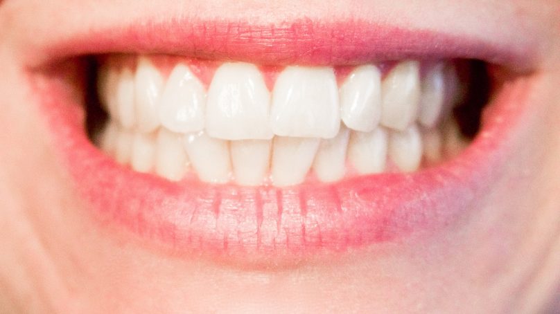 Licówki – skuteczny sposób na proste i białe zęby!