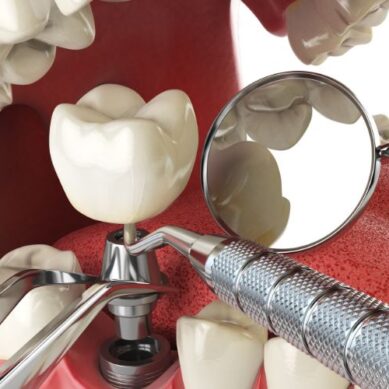 Implanty zębów – najważniejsze informacje dla zainteresowanych
