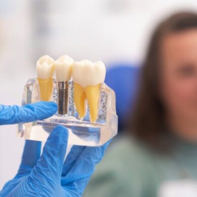 Cena implantów zębowych – od czego zależy?
